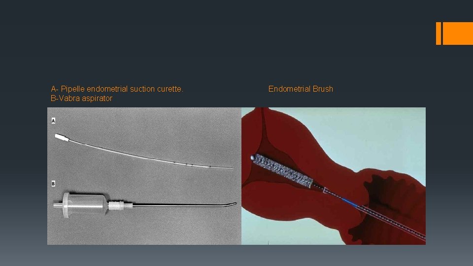 A- Pipelle endometrial suction curette. B-Vabra aspirator Endometrial Brush 