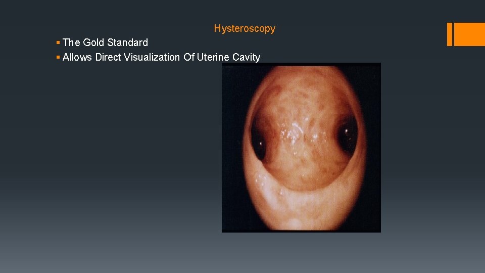 Hysteroscopy § The Gold Standard § Allows Direct Visualization Of Uterine Cavity 