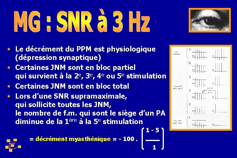  • Le décrément du PPM est physiologique (dépression synaptique) • Certaines JNM sont