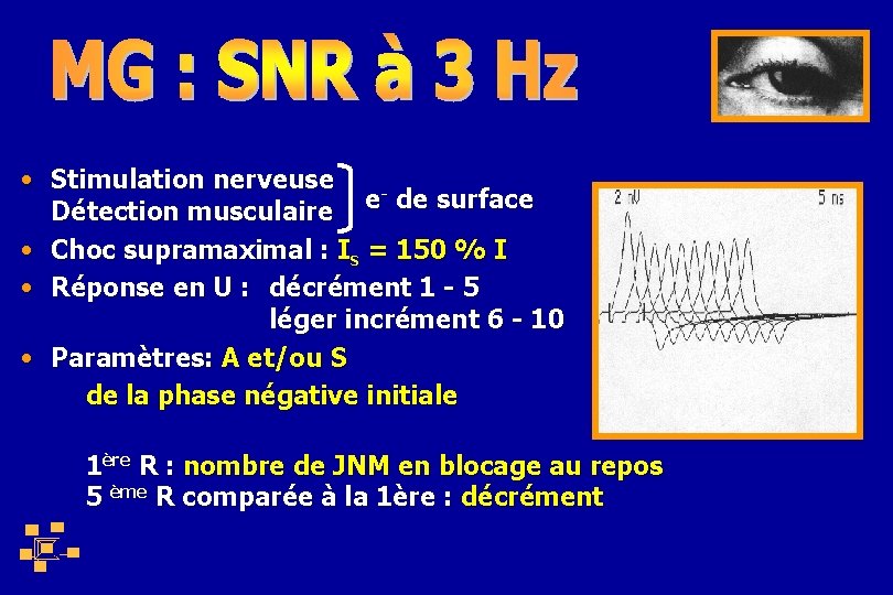  • Stimulation nerveuse - de surface e Détection musculaire • Choc supramaximal :