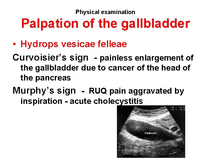 Physical examination Palpation of the gallbladder • Hydrops vesicae felleae Curvoisier’s sign - painless