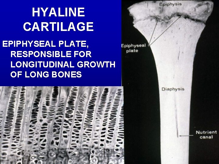 HYALINE CARTILAGE EPIPHYSEAL PLATE, RESPONSIBLE FOR LONGITUDINAL GROWTH OF LONG BONES 