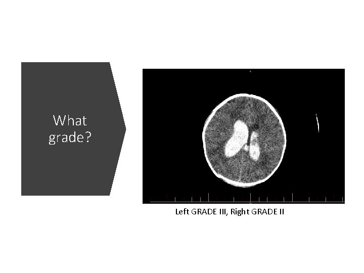 What grade? Left GRADE III, Right GRADE II 