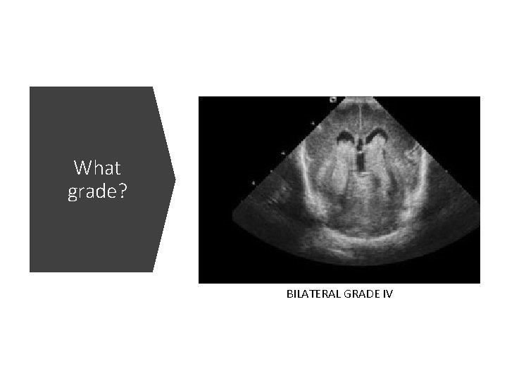 What grade? BILATERAL GRADE IV 