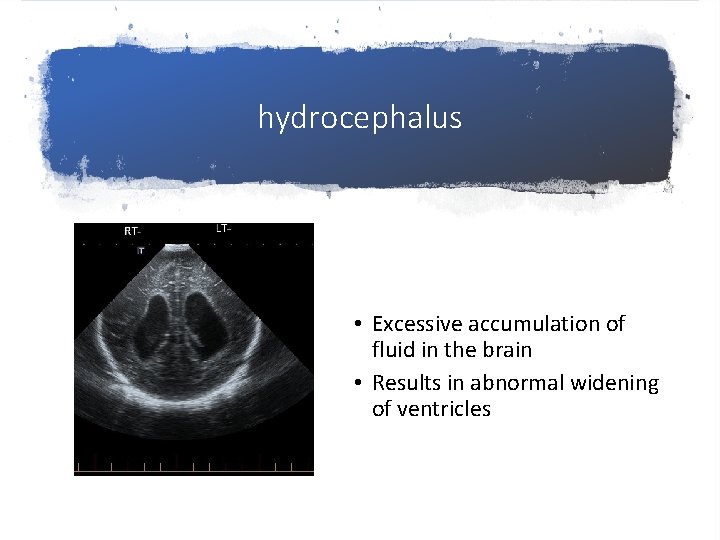 hydrocephalus • Excessive accumulation of fluid in the brain • Results in abnormal widening
