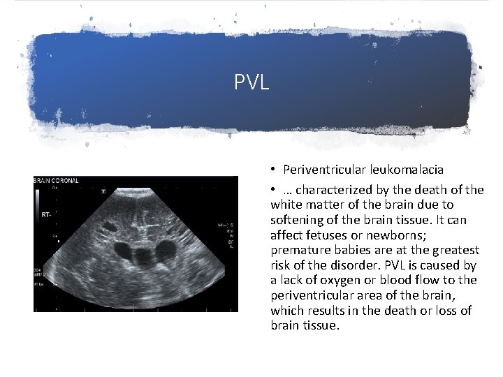 PVL • Periventricular leukomalacia • … characterized by the death of the white matter
