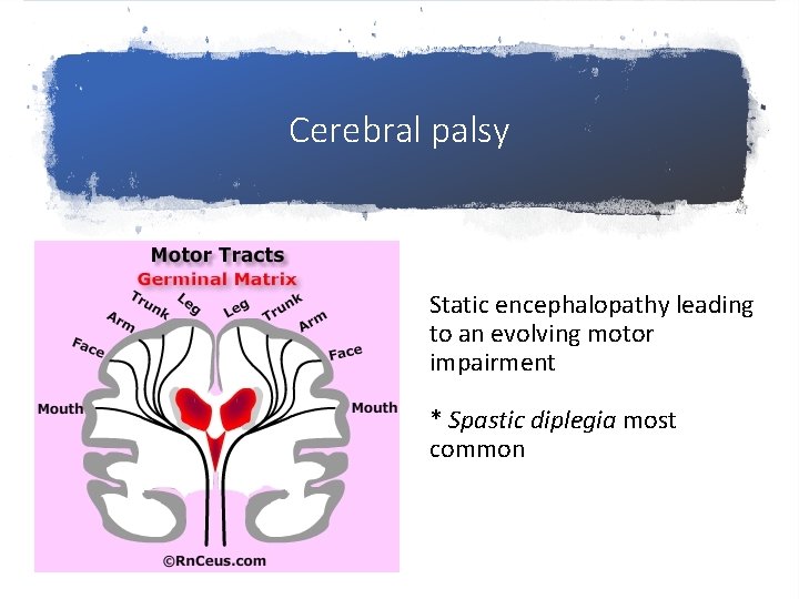 Cerebral palsy Static encephalopathy leading to an evolving motor impairment * Spastic diplegia most