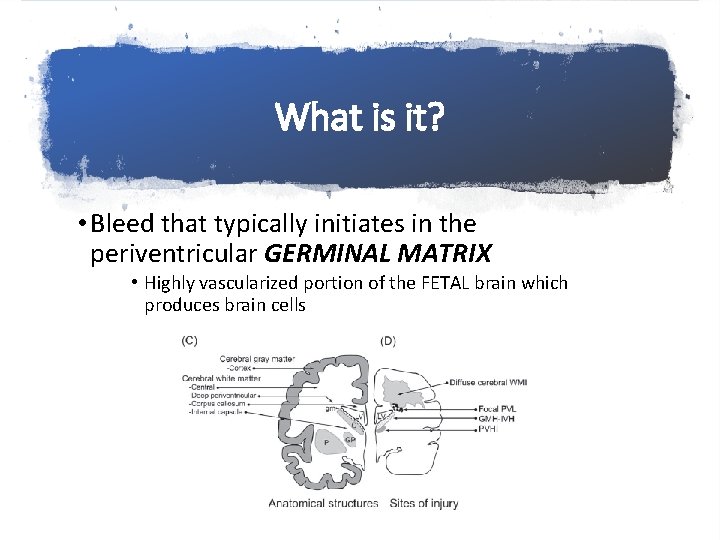 What is it? • Bleed that typically initiates in the periventricular GERMINAL MATRIX •