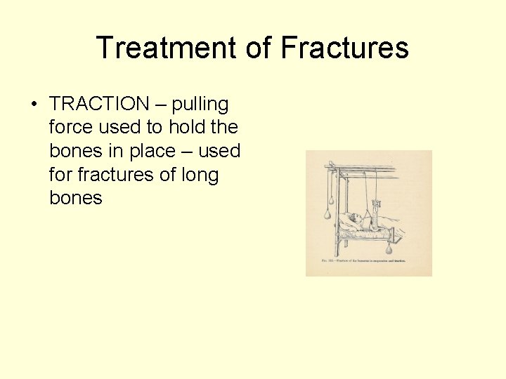 Treatment of Fractures • TRACTION – pulling force used to hold the bones in