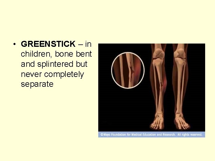  • GREENSTICK – in children, bone bent and splintered but never completely separate