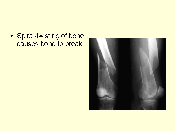  • Spiral-twisting of bone causes bone to break 