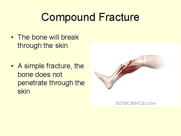 Compound Fracture • The bone will break through the skin • A simple fracture,