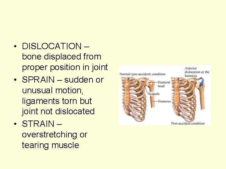  • DISLOCATION – bone displaced from proper position in joint • SPRAIN –