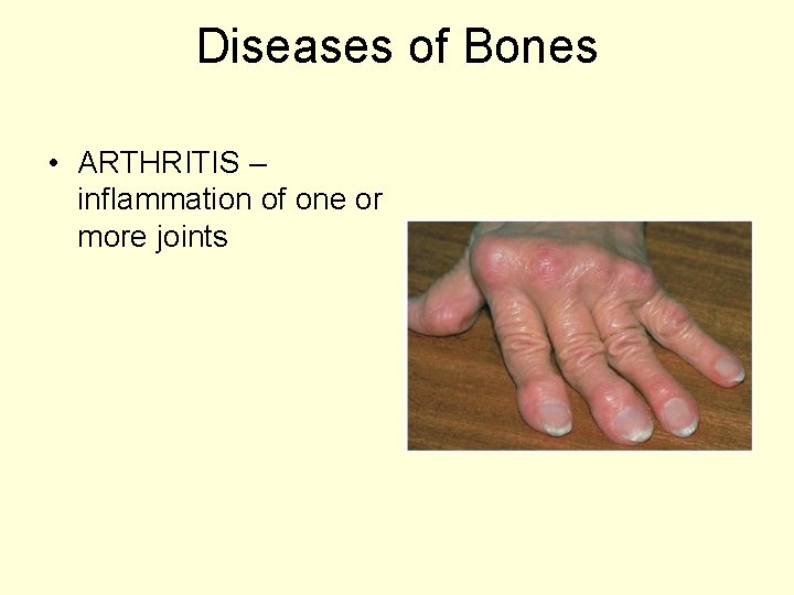 Diseases of Bones • ARTHRITIS – inflammation of one or more joints 