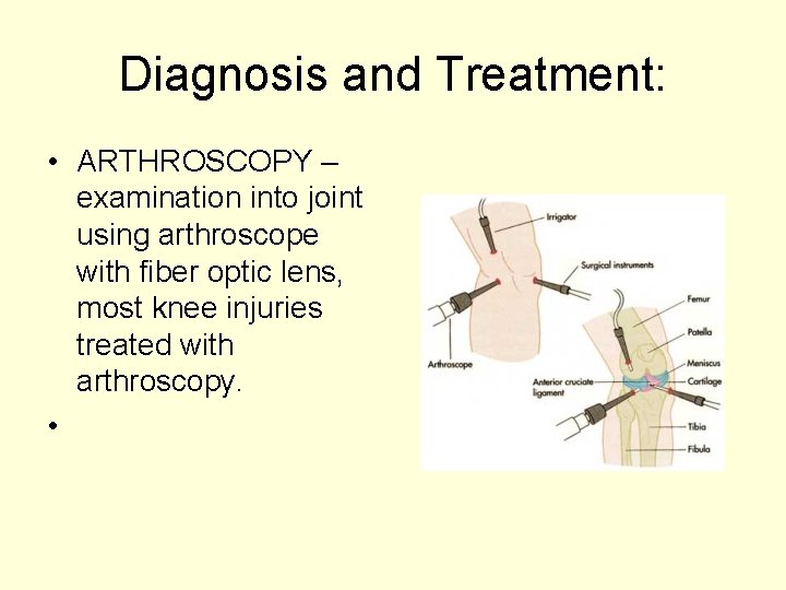 Diagnosis and Treatment: • ARTHROSCOPY – examination into joint using arthroscope with fiber optic