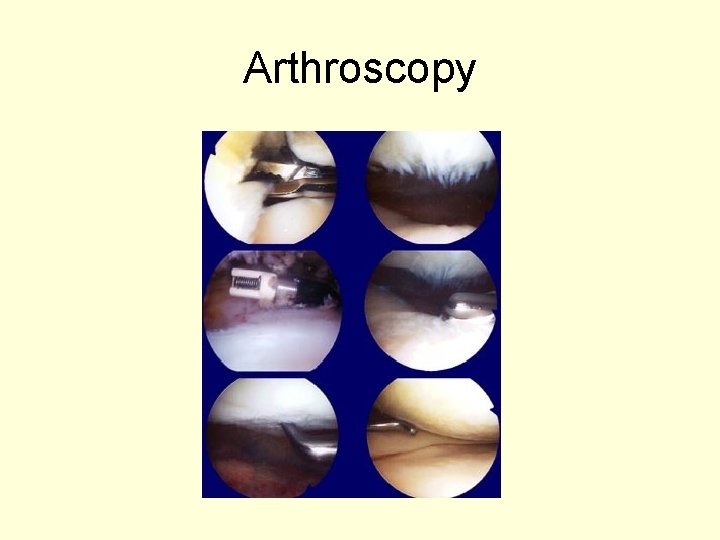 Arthroscopy 