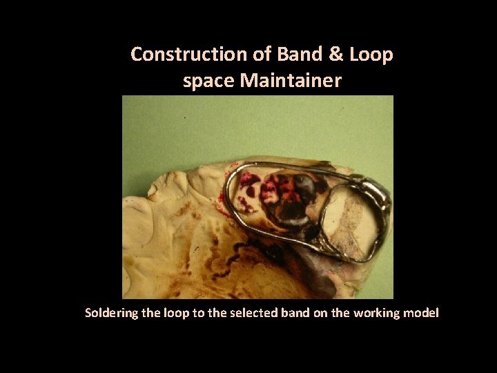 Construction of Band & Loop space Maintainer Soldering the loop to the selected band