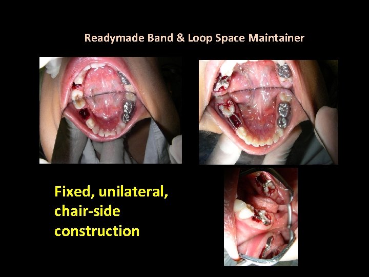 Readymade Band & Loop Space Maintainer Fixed, unilateral, chair-side construction 