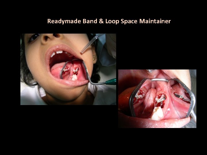 Readymade Band & Loop Space Maintainer 