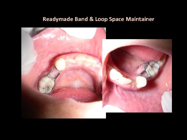 Readymade Band & Loop Space Maintainer 