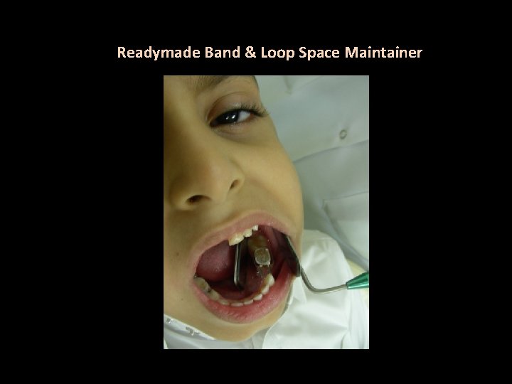 Readymade Band & Loop Space Maintainer 