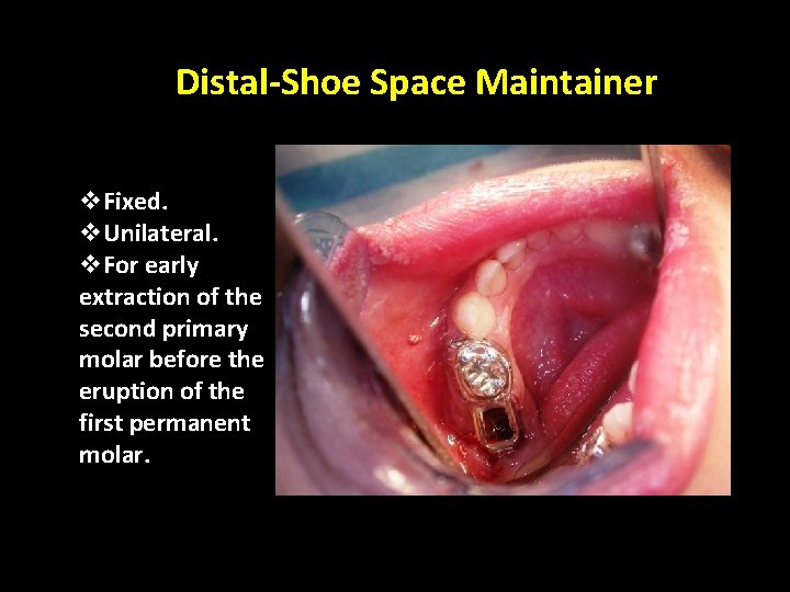 Distal-Shoe Space Maintainer v. Fixed. v. Unilateral. v. For early extraction of the second