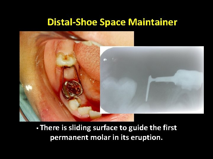 Distal-Shoe Space Maintainer § There is sliding surface to guide the first permanent molar