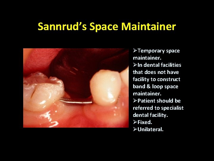 Sannrud’s Space Maintainer ØTemporary space maintainer. ØIn dental facilities that does not have facility