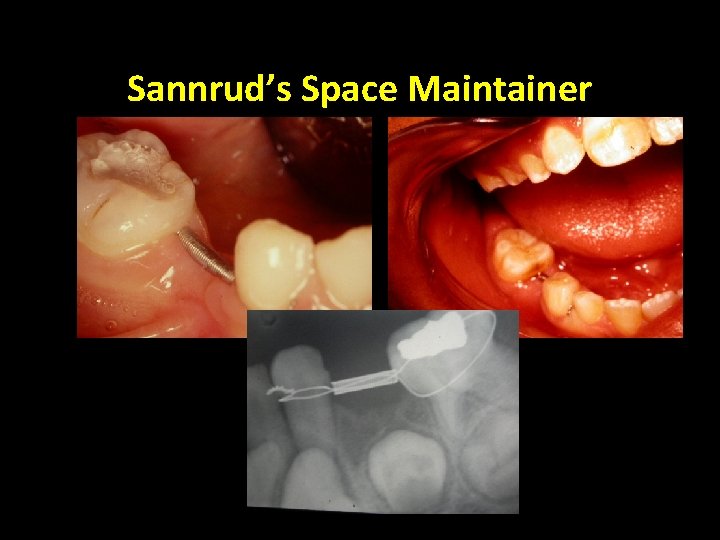 Sannrud’s Space Maintainer 