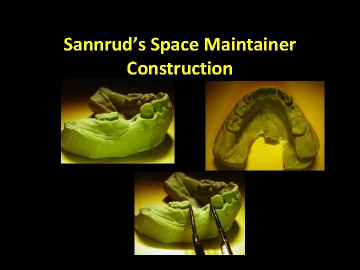 Sannrud’s Space Maintainer Construction 