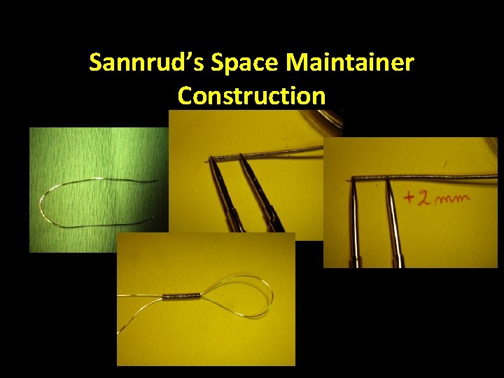 Sannrud’s Space Maintainer Construction 