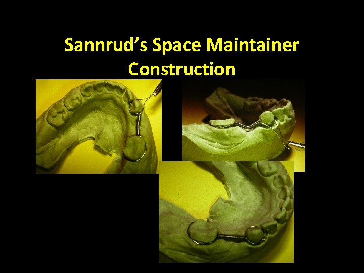 Sannrud’s Space Maintainer Construction 