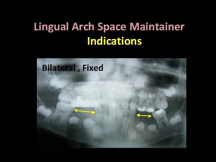Lingual Arch Space Maintainer Indications Bilateral , Fixed 