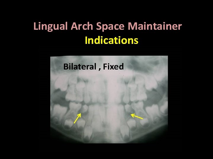 Lingual Arch Space Maintainer Indications Bilateral , Fixed 