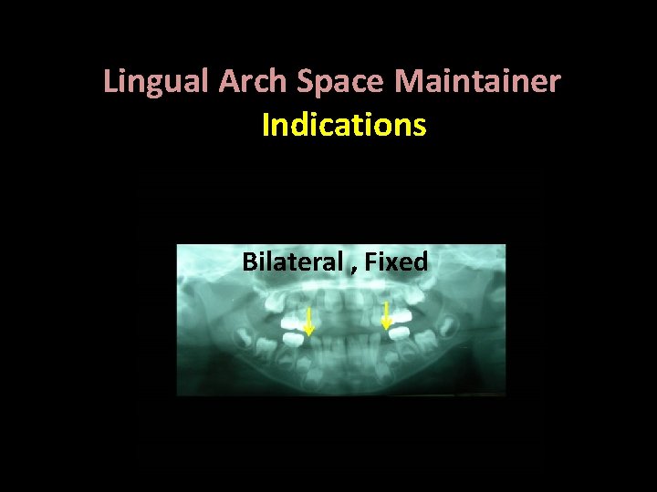 Lingual Arch Space Maintainer Indications Bilateral , Fixed 
