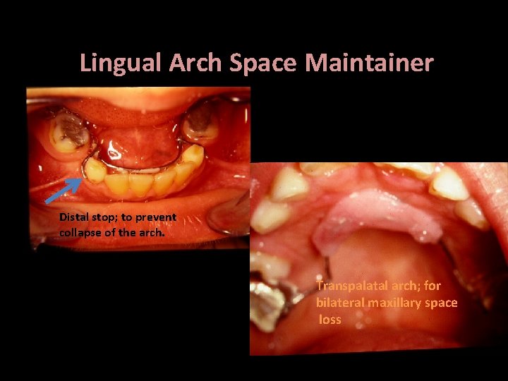 Lingual Arch Space Maintainer Distal stop; to prevent collapse of the arch. Bilateral ,