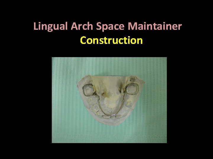 Lingual Arch Space Maintainer Construction Bilateral , Fixed 