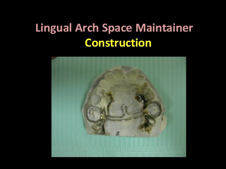 Lingual Arch Space Maintainer Construction Bilateral , Fixed 