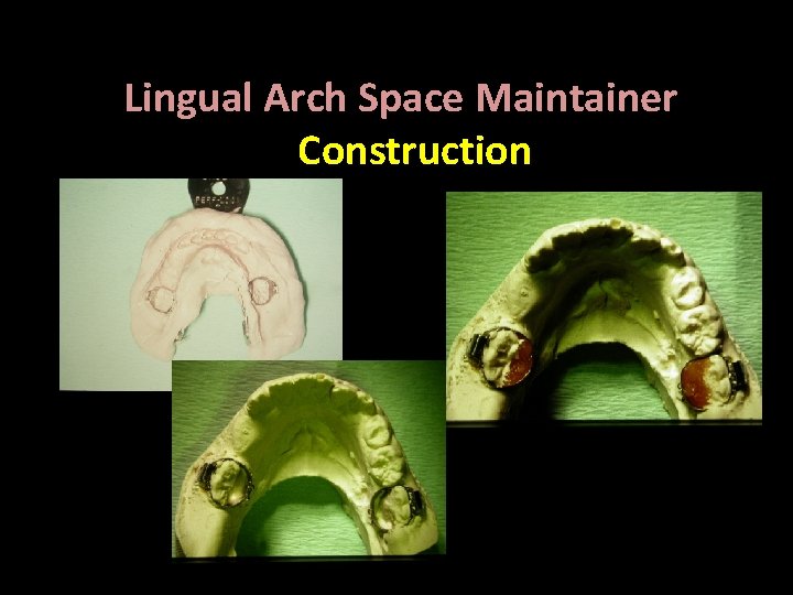 Lingual Arch Space Maintainer Construction Bilateral , Fixed 