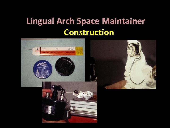 Lingual Arch Space Maintainer Construction Bilateral , Fixed 