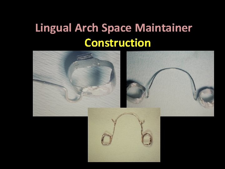 Lingual Arch Space Maintainer Construction Bilateral , Fixed 