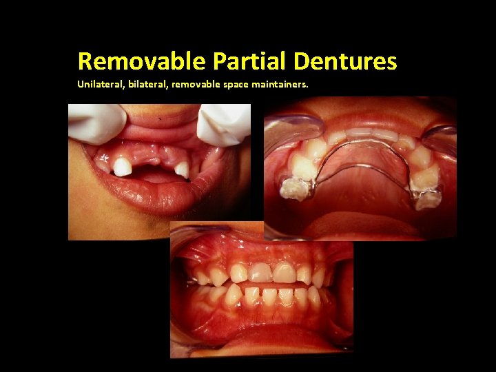 Removable Partial Dentures Unilateral, bilateral, removable space maintainers. Bilateral , Fixed 