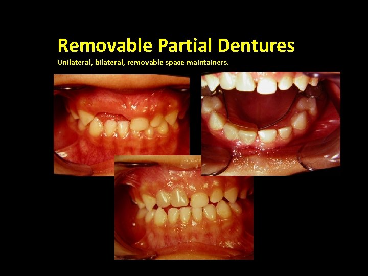 Removable Partial Dentures Unilateral, bilateral, removable space maintainers. Bilateral , Fixed 