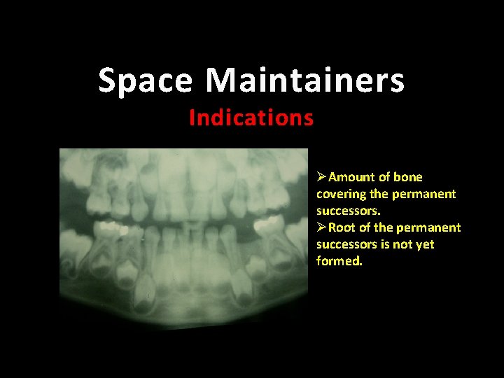 Space Maintainers Indications ØAmount of bone covering the permanent successors. ØRoot of the permanent
