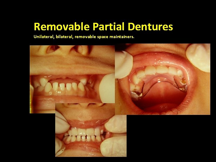Removable Partial Dentures Unilateral, bilateral, removable space maintainers. Bilateral , Fixed 