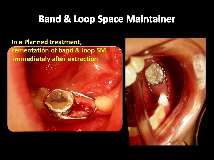Band & Loop Space Maintainer In a Planned treatment, cementation of band & loop