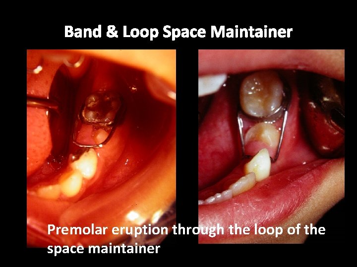 Band & Loop Space Maintainer Premolar eruption through the loop of the space maintainer