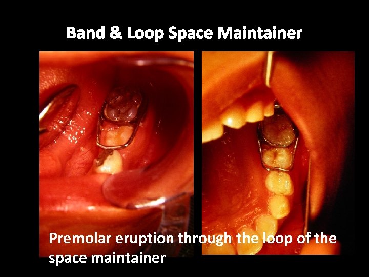 Band & Loop Space Maintainer Premolar eruption through the loop of the space maintainer