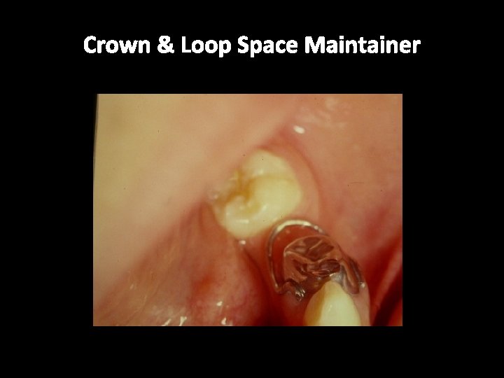 Crown & Loop Space Maintainer 