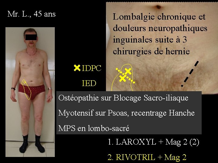 Mr. L. , 45 ans Lombalgie chronique et douleurs neuropathiques inguinales suite à 3